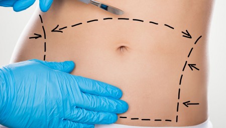 déroulement chirurgie du ventre