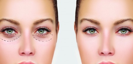 effets blépharoplastie