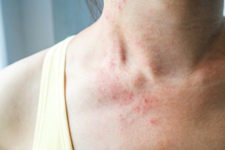 Les maladies en rapport avec la peau