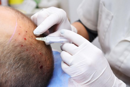 méthode implant cheveux