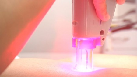 épilation au laser