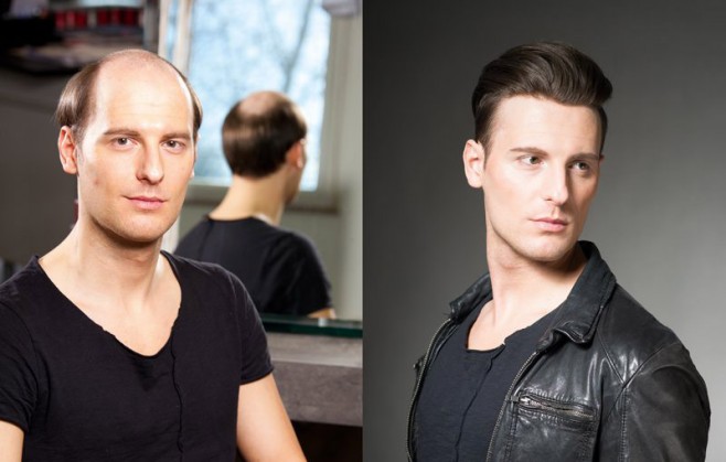 Les différentes techniques de greffe de cheveux